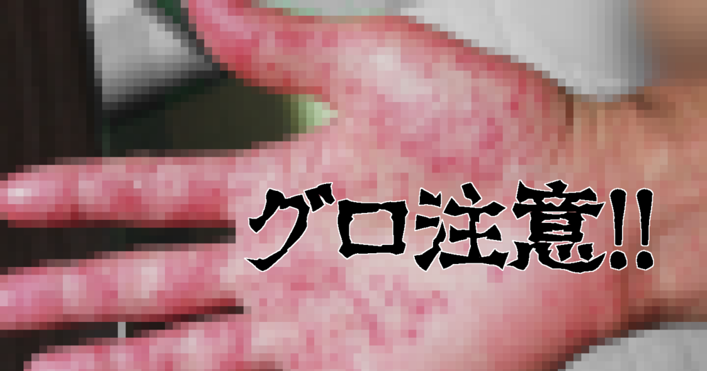 手足口病はどのように治療されますか?